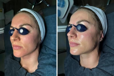 Korean Aqua Peel before and after, three-quarter view, Murray Utah