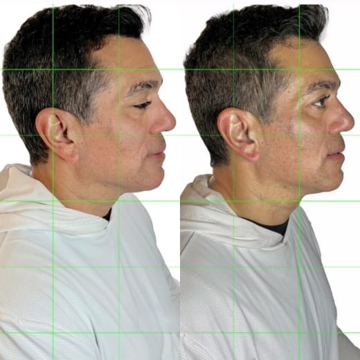 Same client — right lateral view, Restorative Buccal Facial Murray Utah — jaw definition, and neck elongation after one session