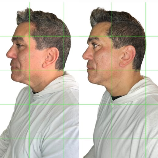 Same client — left lateral view, Restorative Buccal Facial Murray Utah — jawline and chin read more defined after one session