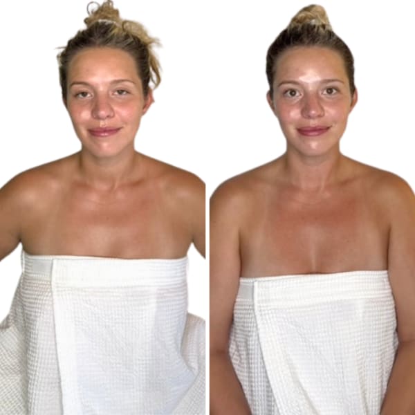 buccal facial before and after front view murray utah altru radiance