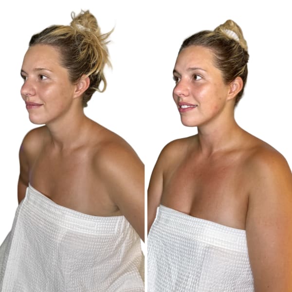 buccal facial before and after left lateral view murray utah altru radiance