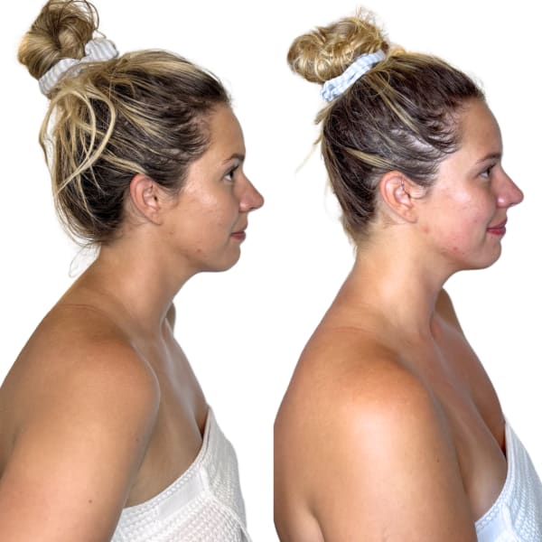 buccal facial before and after right lateral view murray utah altru radiance