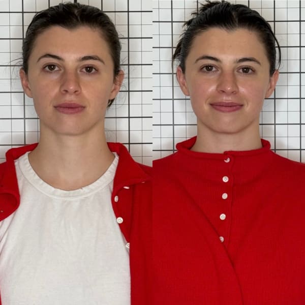 buccal facial before after facial sculpting symmetry murray utah altru radiance