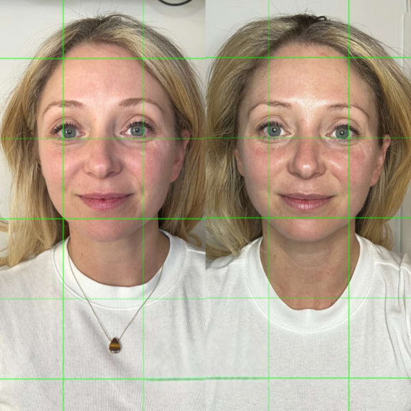 buccal facial before after facial symmetry grid overlay murray utah altru radiance