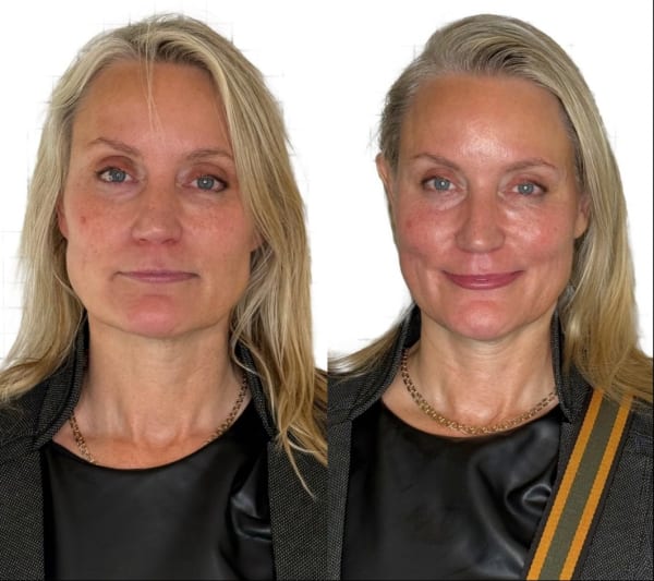 buccal facial before after fascia work sculpted features murray utah altru radiance