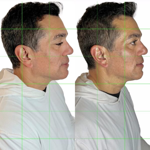 buccal facial before after jaw definition neck elongation murray utah altru radiance