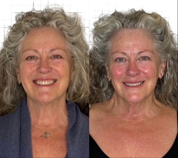 buccal facial before after lymphatic skin vitality puffiness murray utah altru radiance
