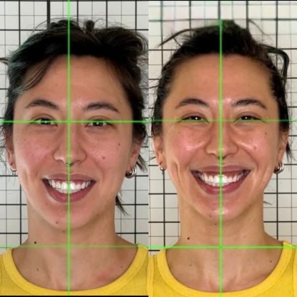 buccal facial before after facial symmetry and balance murray utah altru radiance
