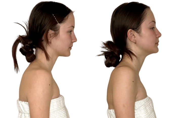 Buccal massage before and after one Restorative Buccal Facial, right profile: sharper jaw angle and a cleaner line from chin to neck, Murray, Utah
