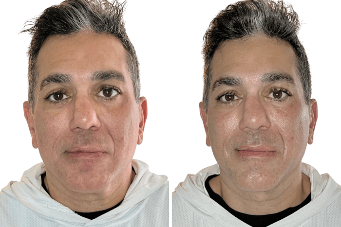 Buccal massage before and after one Restorative Buccal Facial on a male client, front view: a cleaner jaw-to-neck line, smoother-looking neck creases and a narrower lower face, Murray, Utah