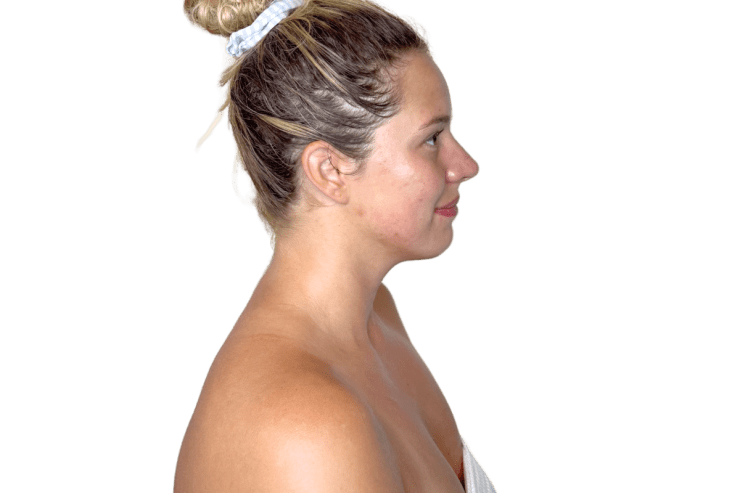 Restorative Buccal Facial side profile after one session — softening through the neck and neck elongation, Murray Utah Altru Radiance