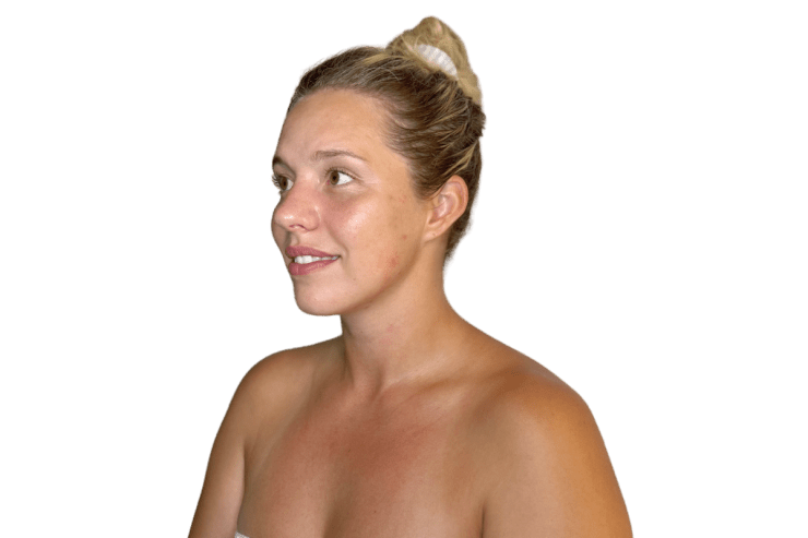 Restorative Buccal Facial three-quarter view after one session — midface lifted, cheekbone re-emerged, Murray Utah Altru Radiance