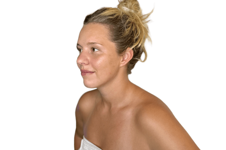 Restorative Buccal Facial three-quarter view before — midface settled, fascia dehydrated, Murray Utah Altru Radiance