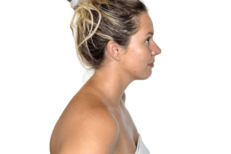The Restorative Buccal Facial side profile before — neck pattern and heaviness through the neck, Murray Utah Altru Radiance