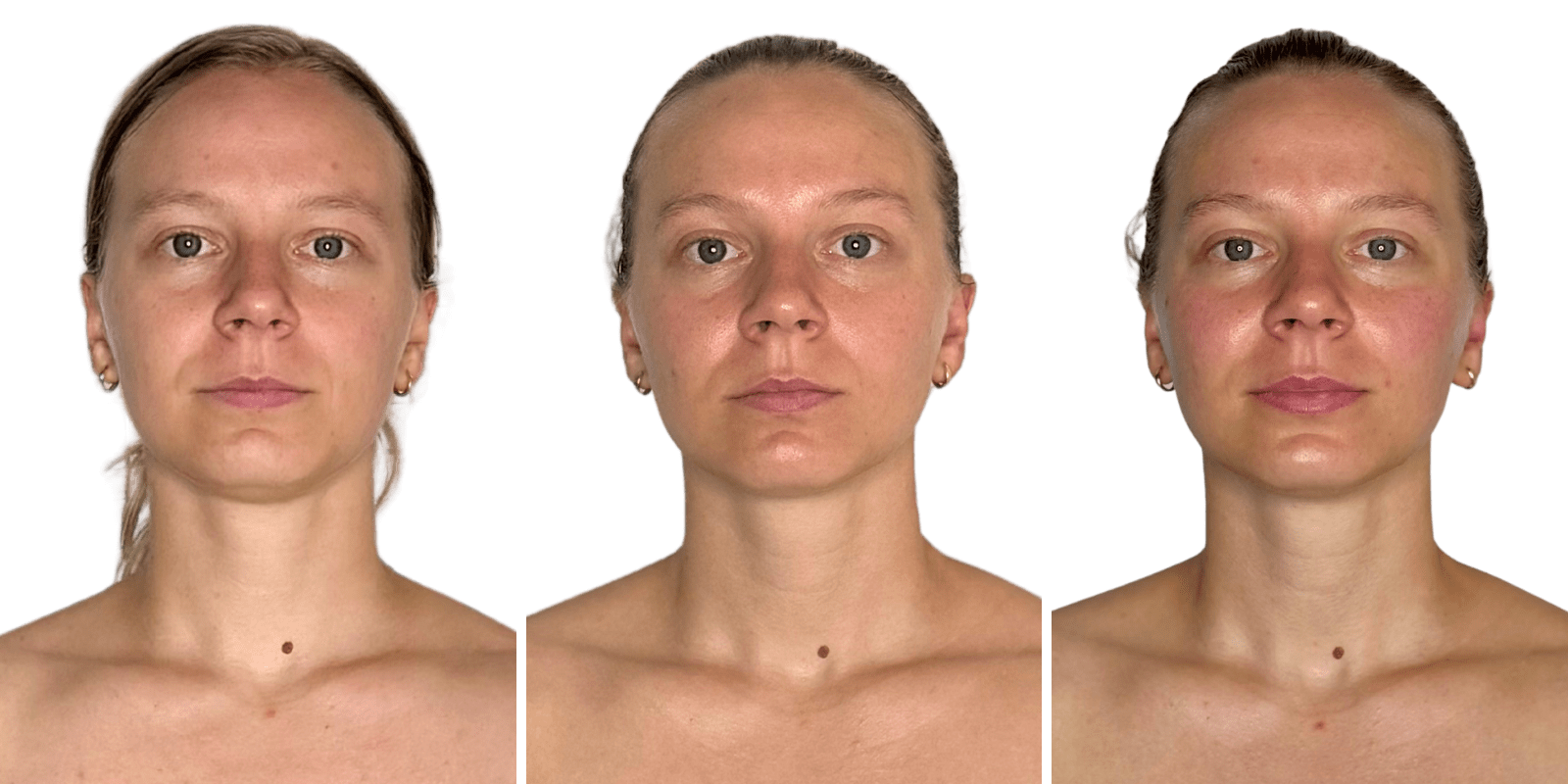 foundation package progression buccal facial fascia regeneration before after multi-session murray utah altru radiance