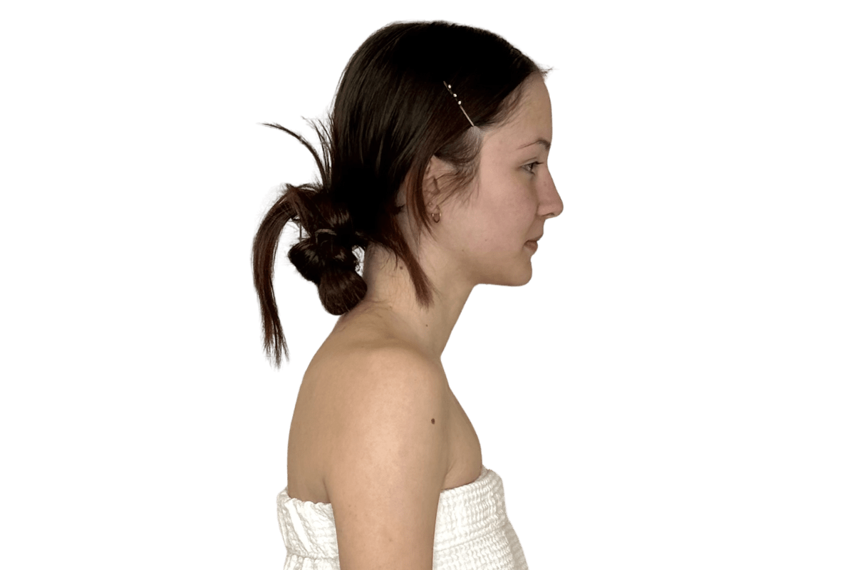 Before structural integration at Altru Radiance — forward head posture, submental fullness, compressed cervical alignment