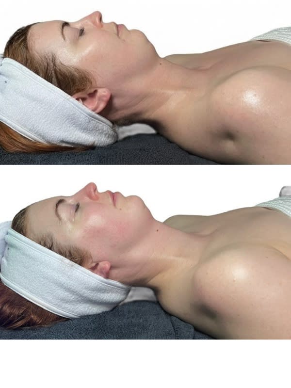 Before and after the Facial Architecture Ritual at Altru Radiance Murray Utah, neck elongation and under-chin definition visible in one session