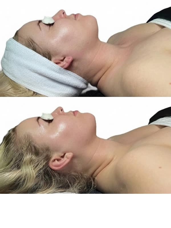 Before and after buccal facial and lymphatic drainage lift at Altru Radiance Murray Utah, visible jawline definition and lymphatic drainage in one session