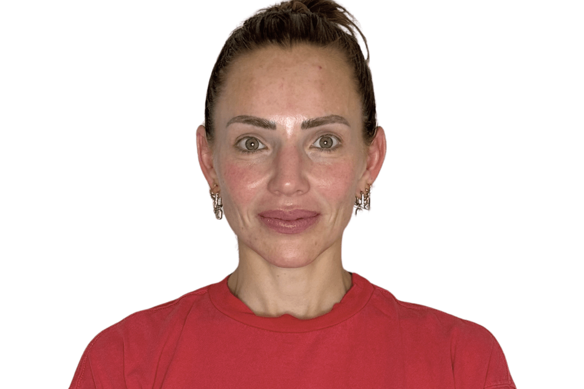 After Restorative Buccal Facial — jawline definition re-emerged, masseter eased, mandibular contour re-emerged, best facial for jawline Salt Lake City