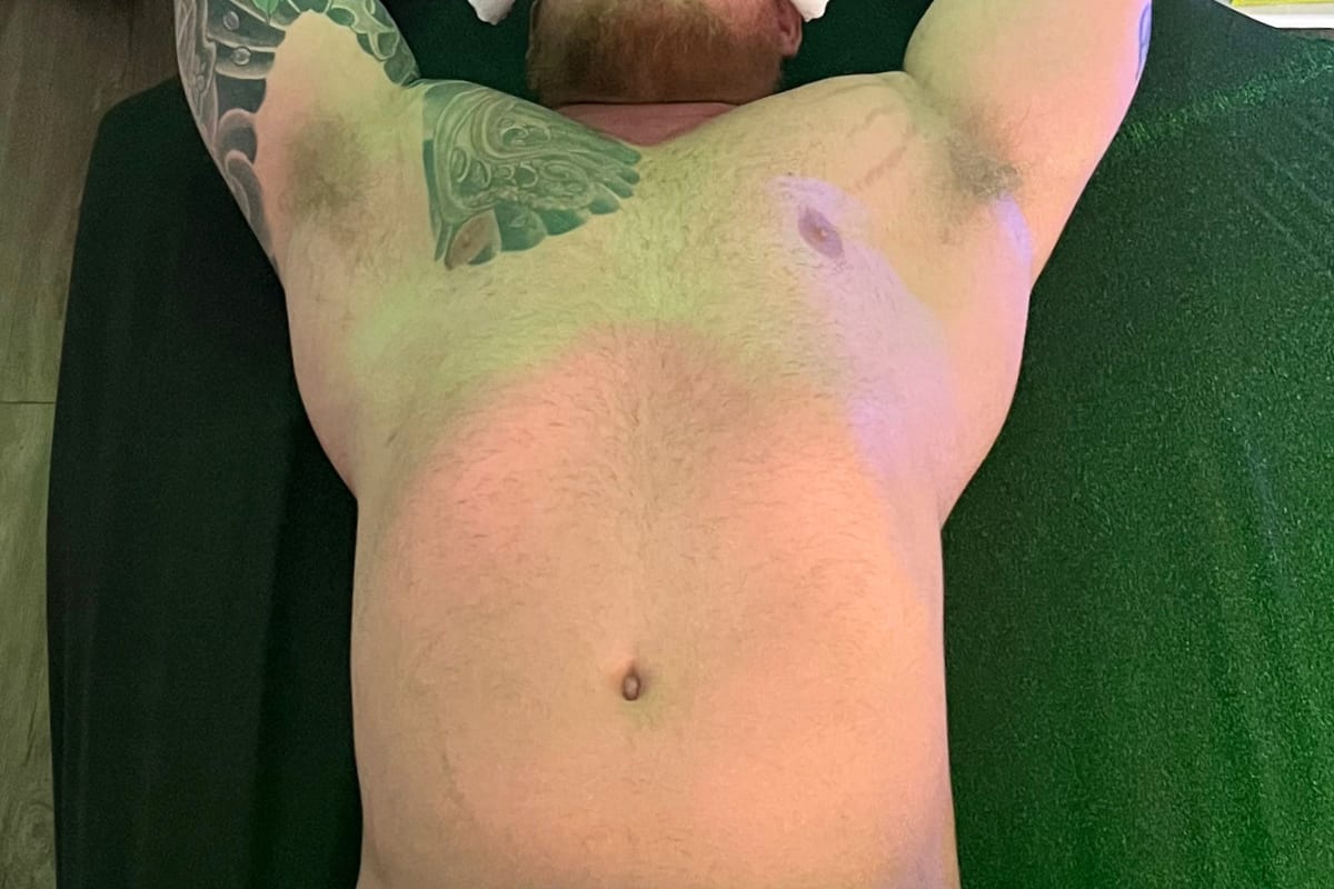 Before SOOTHE lymphatic drainage in-treatment supine abdominal fullness Murray Utah