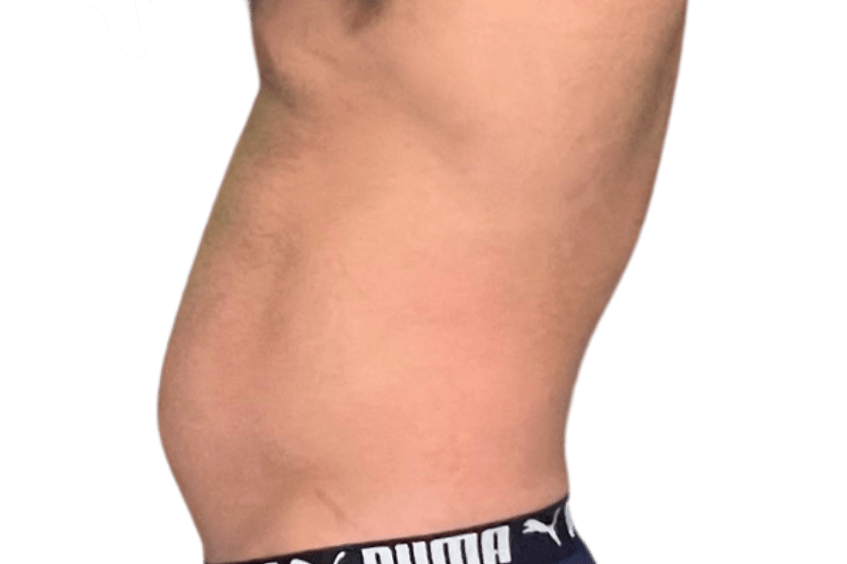 Before SOOTHE lymphatic drainage massage tense fascia fluid retention through the torso fluid load Murray Utah Altru Radiance