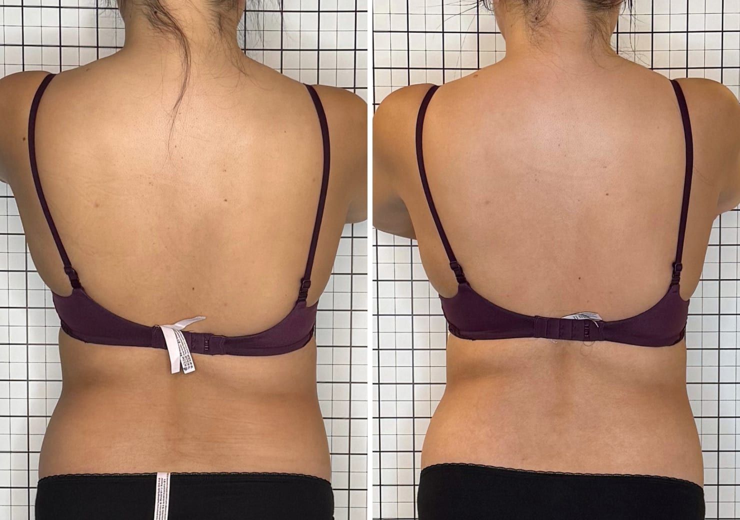 SOOTHE lymphatic drainage before and after back view posterior chain Murray Utah Altru Radiance