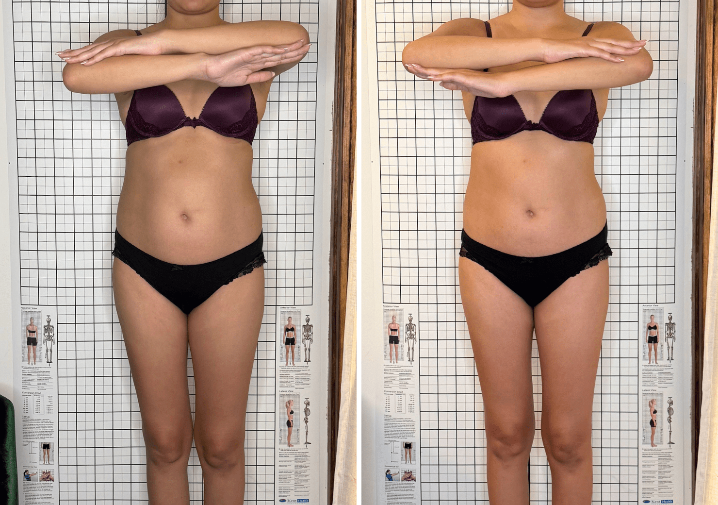 SOOTHE lymphatic drainage before and after stomach debloating result Murray Utah Altru Radiance