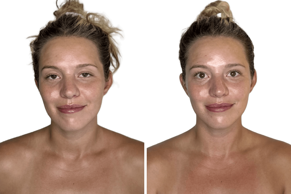 buccal facial before after lymphatic luminosity facial lift symmetry front view 1 session murray utah altru radiance