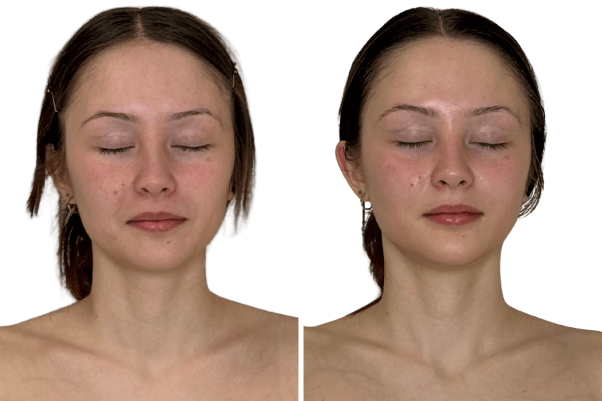 buccal facial before after décolleté neckline definition facial lift front view 1 session murray utah altru radiance