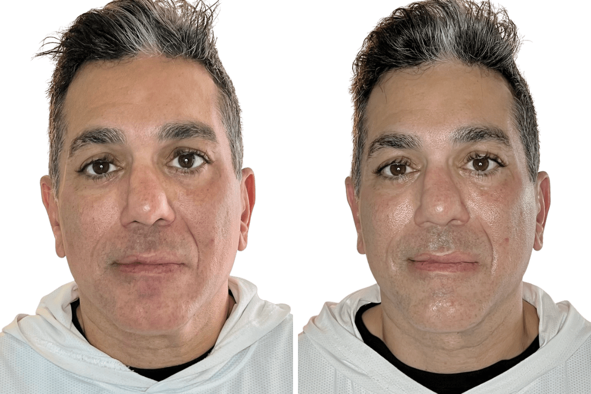 buccal facial before after male jaw symmetry facial definition front view 1 session murray utah altru radiance