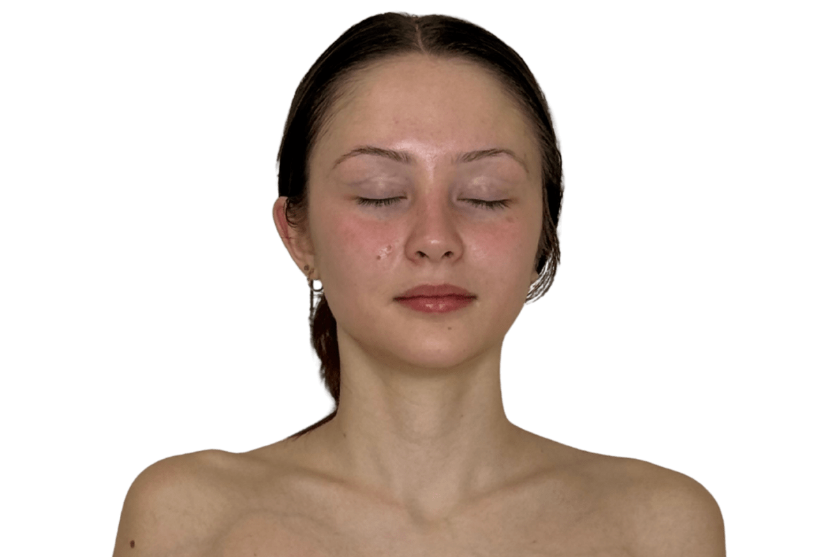 After one Restorative Buccal Facial at Altru Radiance Murray Utah — softer jawline, lifted lower face