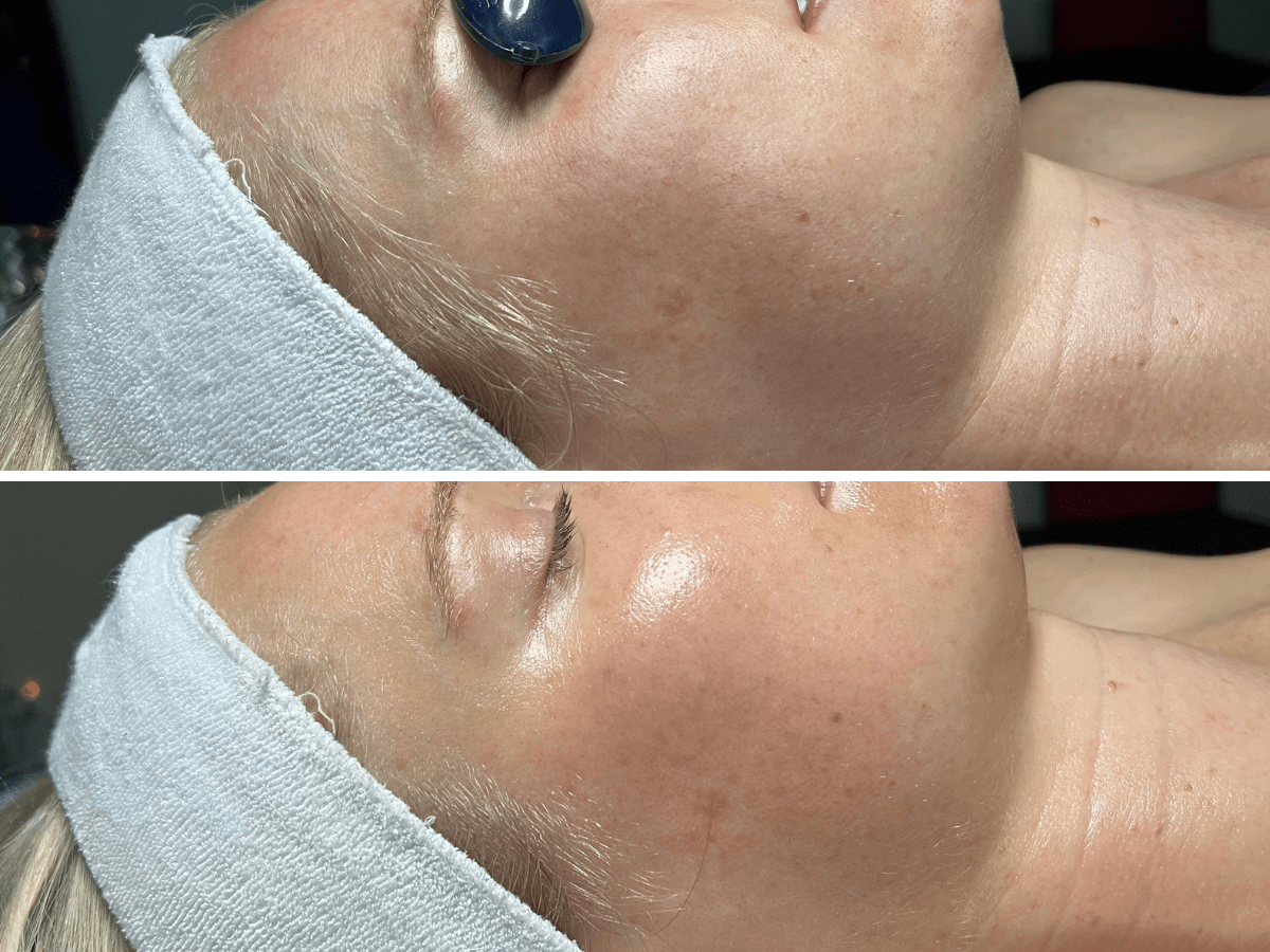 korean aqua peel before after glass skin luminosity right profile 1 session murray utah altru radiance