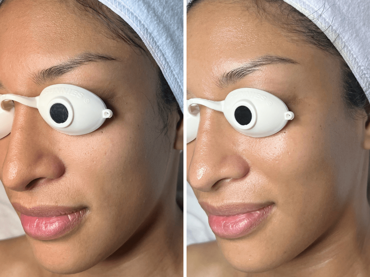 korean aqua peel before after skin clarity pore refinement three quarter 1 session murray utah altru radiance