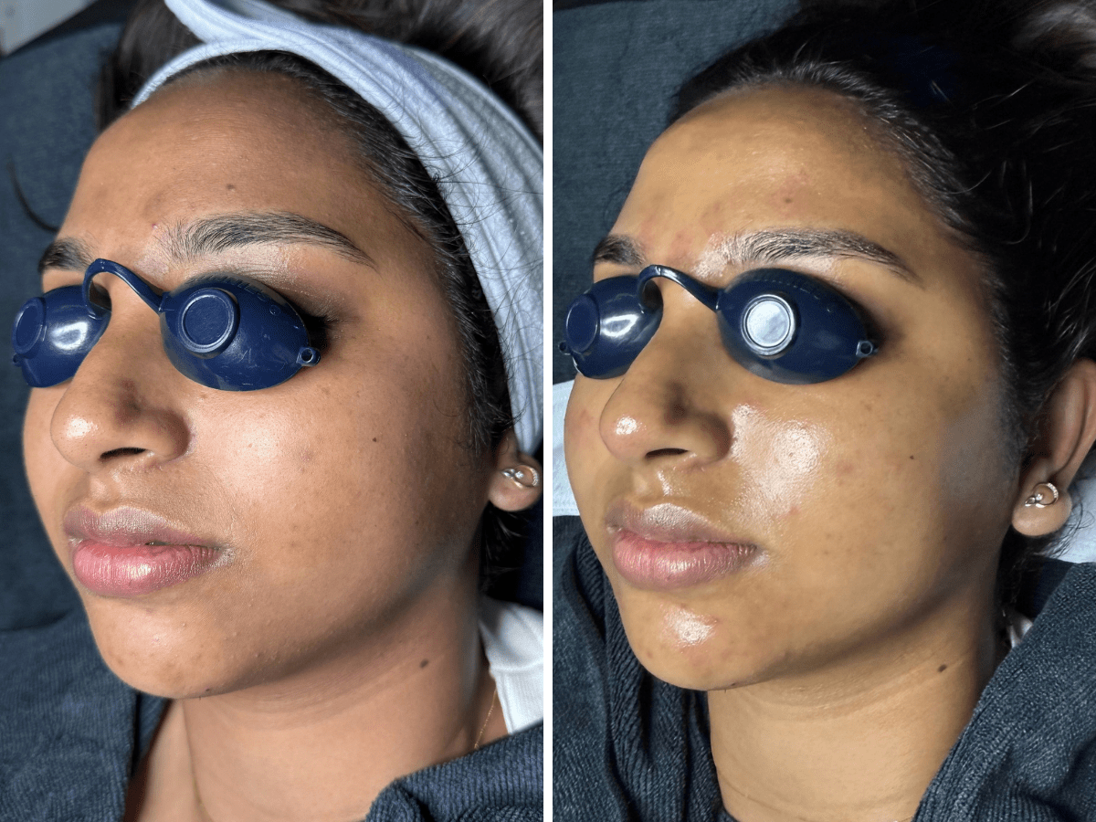 korean aqua peel before after texture clarity pore refinement three quarter 1 session murray utah altru radiance
