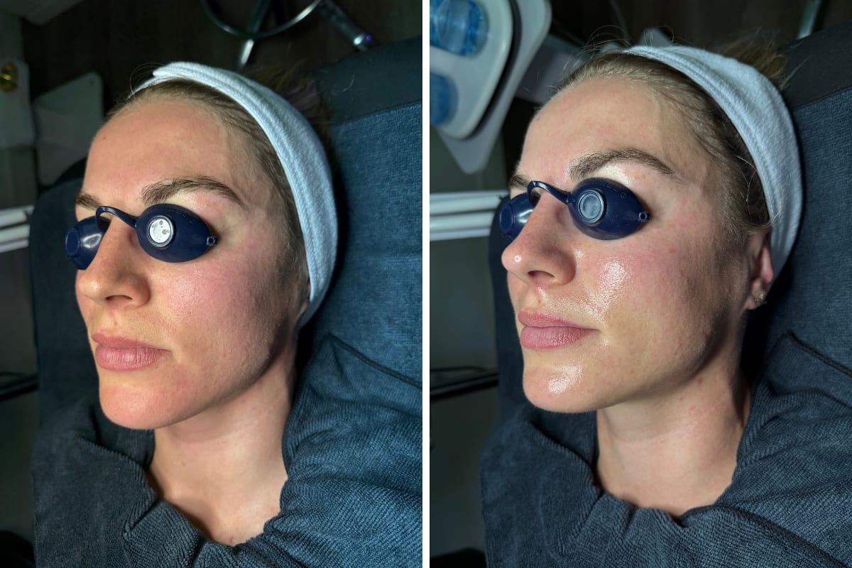 korean aqua peel before after even tone calm surface three quarter 1 session murray utah altru radiance