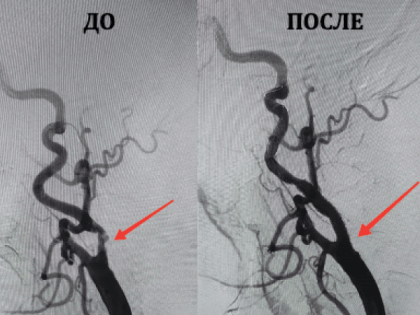 72-летнему пенсионеру первому в мурманской «Пироговке» сделали стентирование сонных артерий