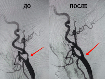 Ангиогирурги «Пироговки» впервые выполнили стентирование сонных артерий