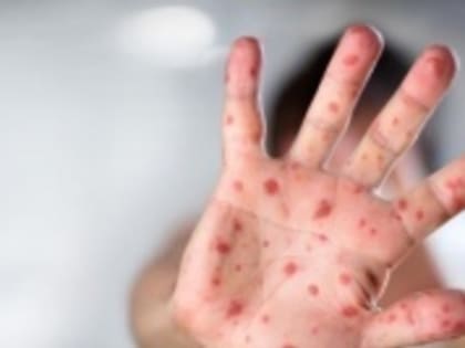 Профилактика кори