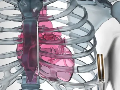 Хирурги ММЦ имени Н.И. Пирогова провели уникальные сердечные операции