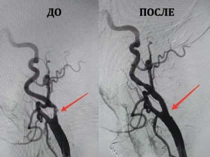 Впервые выполнили стентирование сонных артерий врачи мурманской «Пироговки»