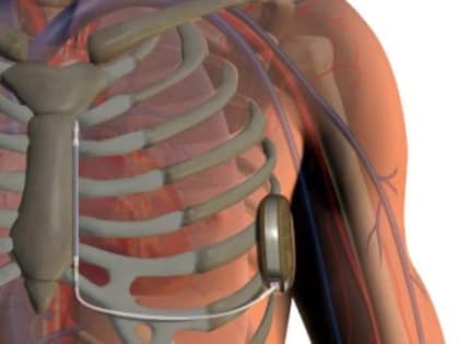 Имплантации кардиостимулирующих устройств нового поколения впервые выполнили в Мурманской области