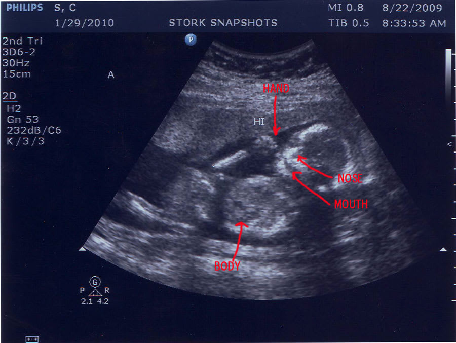 Baby A, in repose