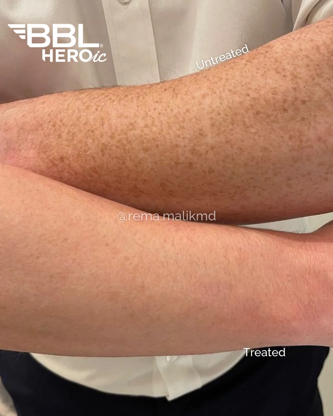 BBL HEROic™: Sun spots on the arms, treated vs untreated