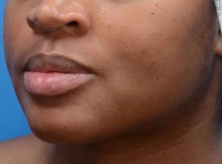 After: MOXI™ Laser, Deeper skin tone