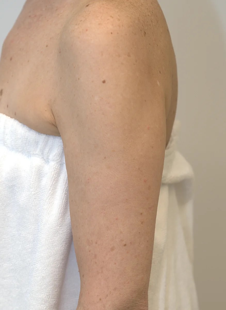 After: BBL HEROic™, Sun spots on the upper arm