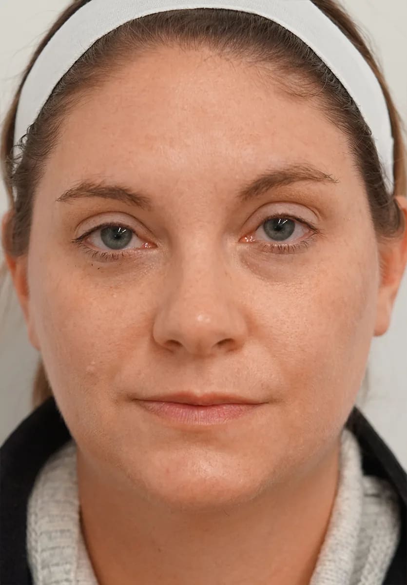 After: BBL HEROic™, Freckles and sun spots
