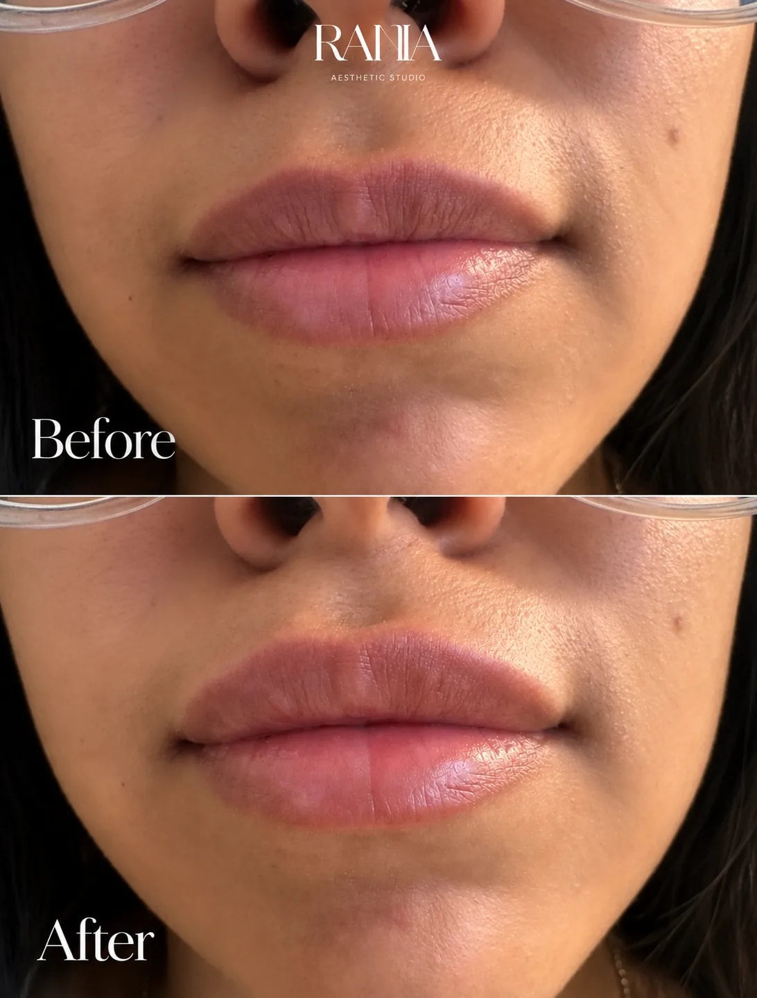 Lip Filler: Natural volume