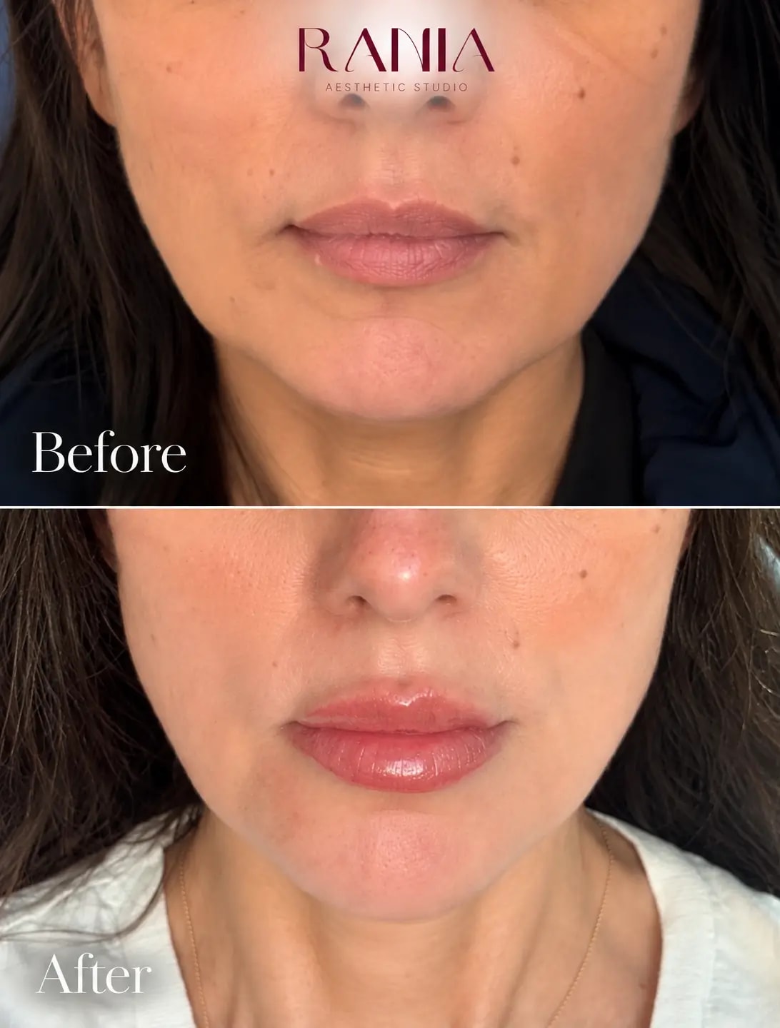 Lip Filler: Fuller, defined lips