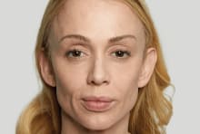 Anna before treatment