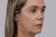 Flavia before treatment